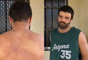 Paciente com dermatite atópica luta na Justiça por tratamento de R$ 150 mil